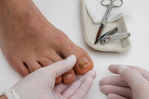 soigner-mycose-pieds